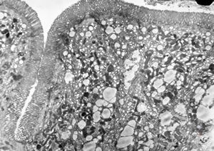 M,29y. | jejunum - lipid malabsorption M,29y. | jejunum - lipid malabsorption